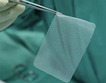 Defective Hernia Mesh Implants